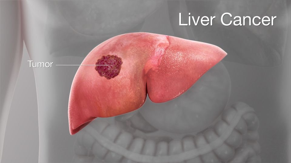 doctor for liver cancer in gurugram